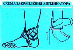 Схема закрепления